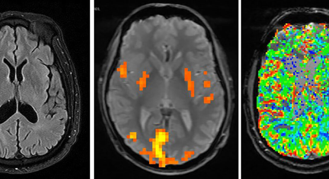 Three images, side by side, including an Brain MRI (left), Functional MR (center), and Brain Perfusion MRI (right).
