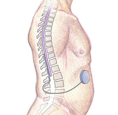 Illustration showing the Intrathecal Pump attached to the spinal cord of a human body