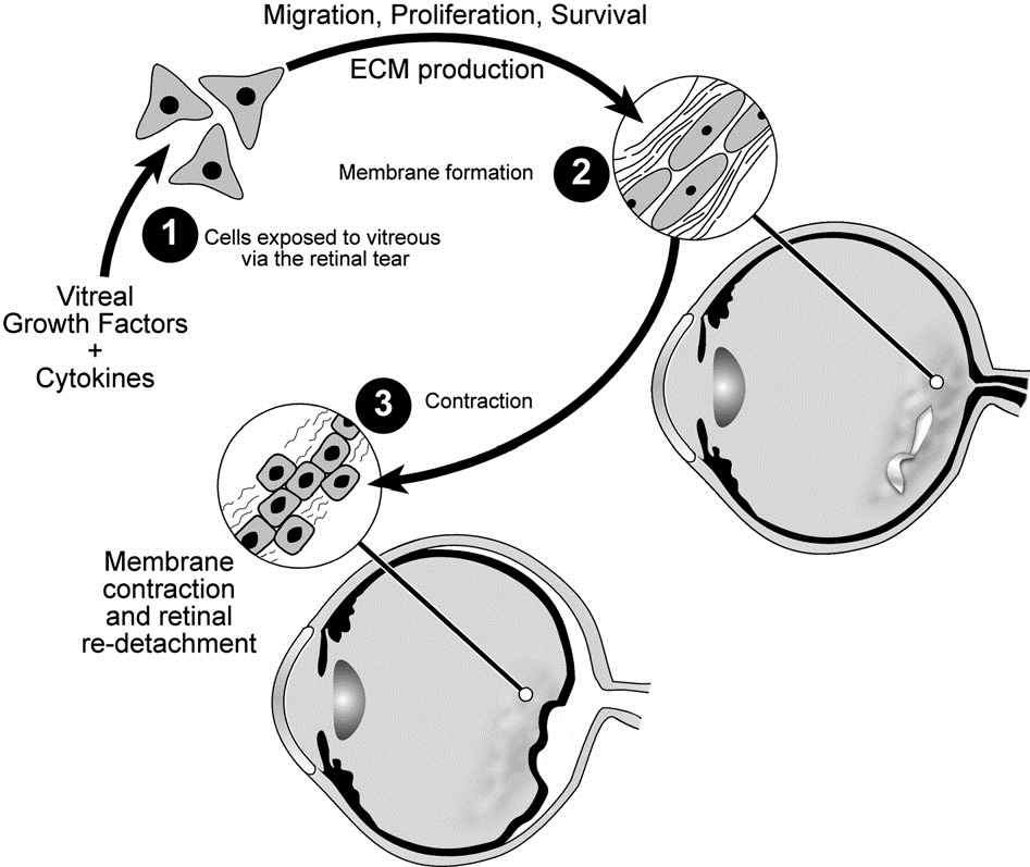 Illustration depicting 3 steps in pathogenesis of PVR