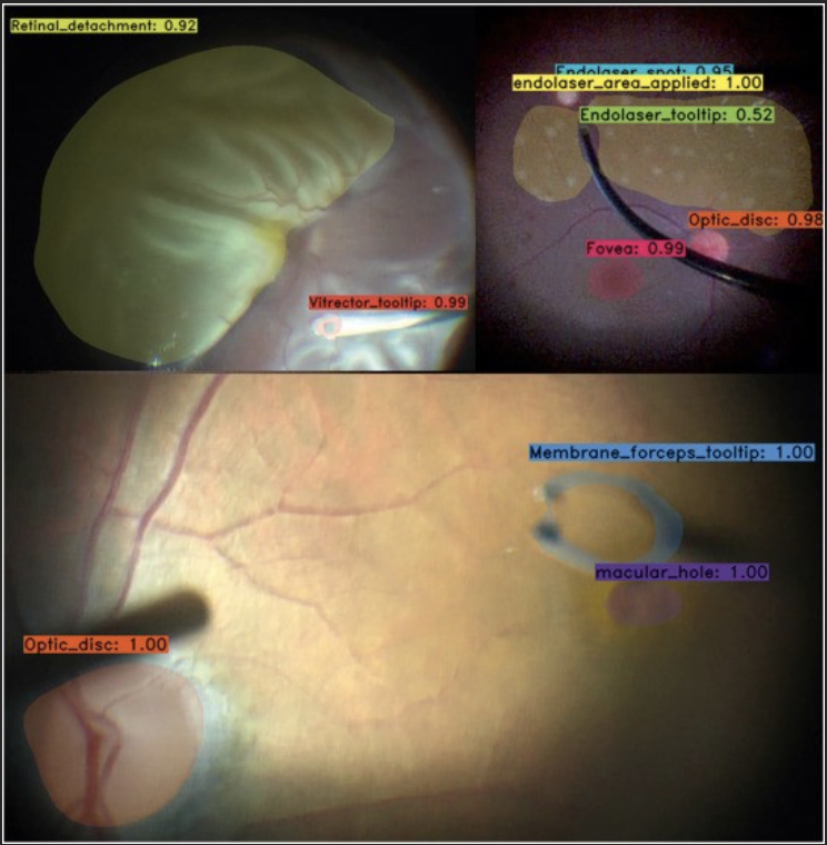 Close up images of retinal detachment