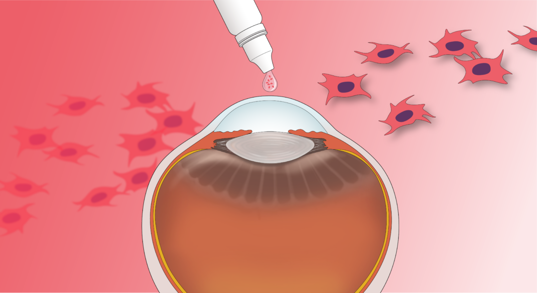 Artistic depiction of topical administration of mesenchymal stem cells to the cornea.