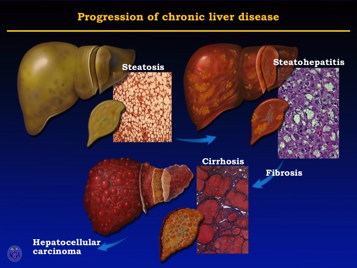 Progression of Chronic liver